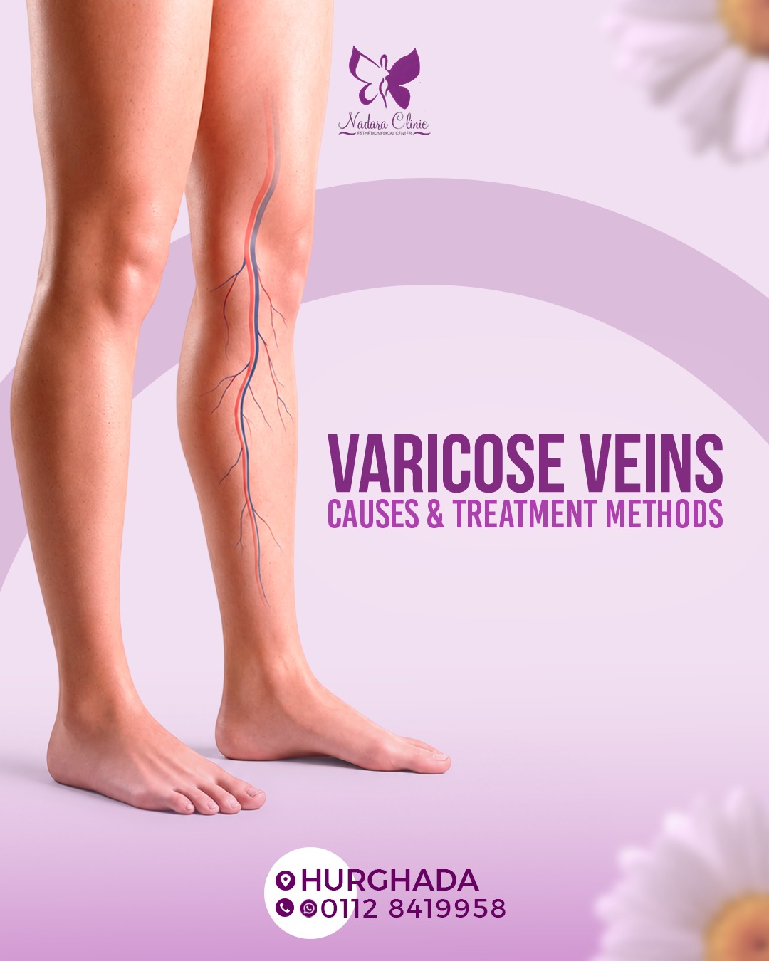 Varicose veins: causes and treatment methods in Hurghada